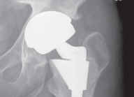 Illustration 30 for The Proxima: Why This Proximally Loading Implant Preserves Bone