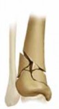 Illustration 7 for Optimizing ORIF for Tibial Plafond Fractures: A Modern Approach