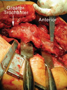 Illustration 23 for Achieving Success with Trochanteric Osteotomy Posterior for Revision