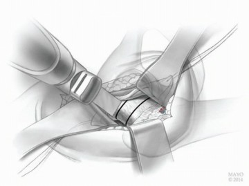 صورة طبية: النهج الأمامي لاستبدال مفصل الورك الكلي: ثورة في جراحة الورك مع الأستاذ الدكتور محمد هطيف في صنعاء