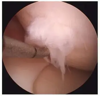 صورة توضيحية لـ التهاب العظم والغضروف السالخ وعيوب الركبة الكبيرة: دليلك الشامل لاستعادة حركة مفاصلك في اليمن والخليج العربي