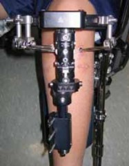 Illustration 18 for Conquering Adolescent Blount's Disease: A Surgical Guide