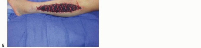 Illustration 25 for Acute Compartment Syndrome: Timely Fasciotomy Explained