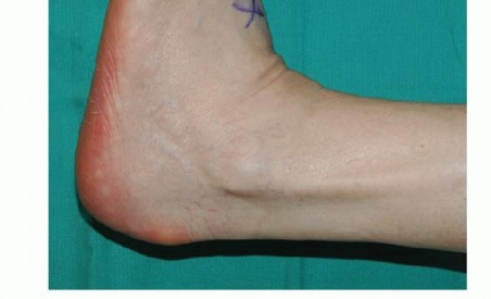 Illustration 23 for Foot Drop Surgery: How a Pin or Drill Elevates Tendon Transfer