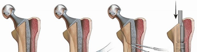 Illustration 23 for Extensively Porouscoated Stems: Proven Success & Superior Fixation