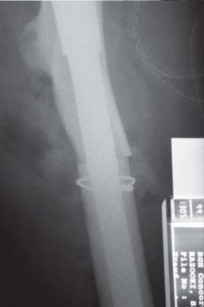 Illustration 138 for Successful Total Hip Replacement in Developmental Dysplasia