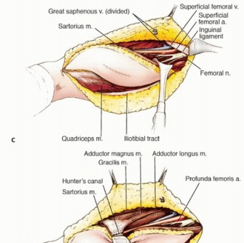 Illustration 17 for Limb-Sparing Quadriceps Resection: Superficial Femoral Artery