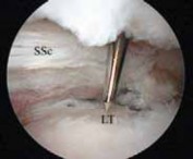 Illustration 31 for Arthroscopic Subscapularis Repair: The lo iky brady Method for Stability