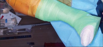 Illustration 16 for PROSTALAC Articulating Spacer: Treat Infected Knees, Regain Mobility