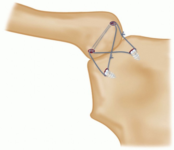 Illustration 23 for Optimizing SC Dislocation Repair After Medial Clavicle Resection