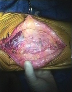 Illustration 8 for Extensor Reconstruction in Total Knee Arthroplasty: Essential Strategies