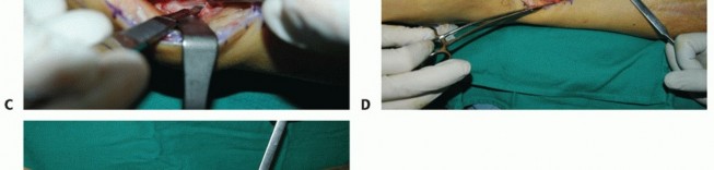 Illustration 46 for Restore Movement: Tendon Transfer for Common Peroneal Nerve Foot Drop