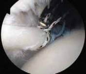 Illustration 16 for Arthroscopic Subscapularis Repair: The lo iky brady Method for Stability