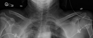 AC Joint Injuries: Spot Symptoms, Understand Anatomy & Types