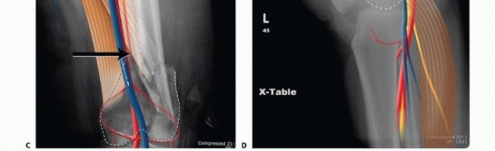 Illustration 6 for Repairing Distal Femur Fractures: Open Reduction & Internal Fixation