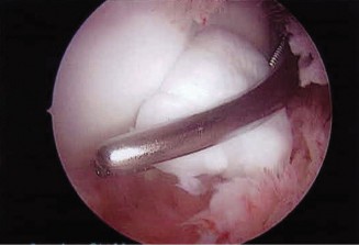 Illustration 4 for Elbow Osteochondritis Dissecans: Diagnosis & Treatment for Athletes