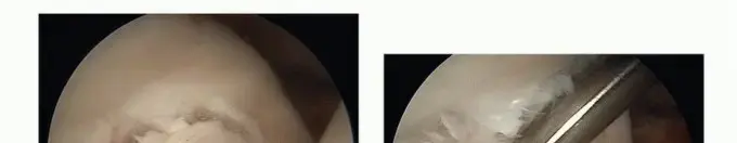 إصابات غضروف الورك: دليل شامل للمرضى نحو التعافي (الأستاذ الدكتور محمد هطيف)