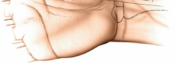 Illustration 183 for Essential Surgical Approaches: Uncover Every Aspect of the Wrist