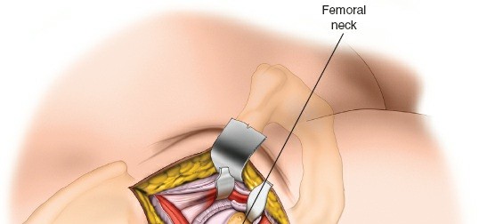 Illustration 93 for Unlocking Every Aspect of the Hip's Surgical Approaches