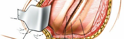 Illustration 315 for Approach to the Lumbar Spine: Mastering Techniques & Anatomy