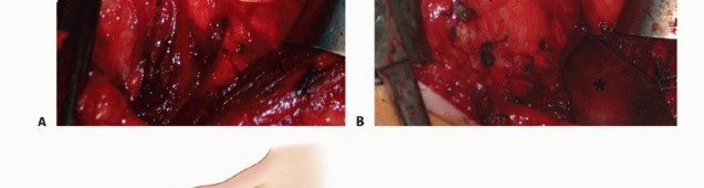 Illustration 14 for Glenoid Bone Graft for Anterior Shoulder Instability: Restore Stability