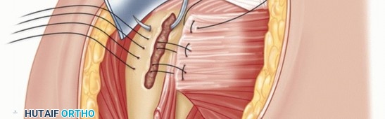 Illustration 16 for Irreparable Subscapularis Tears? Explore Pectoralis Major Transfer.