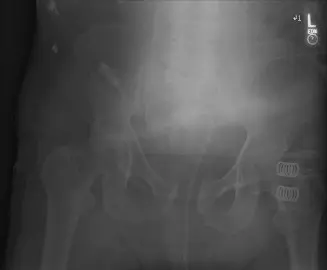 صورة توضيحية لـ كسور الحوض: دليل شامل للمرضى من التشخيص للعلاج والتعافي