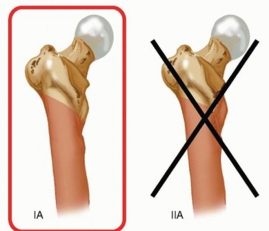 Illustration 7 for Retrograde Femoral Nailing: Optimizing Surgical Outcomes