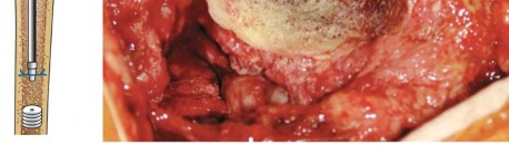 Illustration 22 for Mastering Cementing Technique Femur: A Step-by-Step Guide