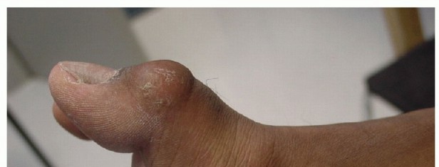 Illustration 36 for Restore Your Foot: Surgical Treatment for Hallux MP Joint Turf Toe