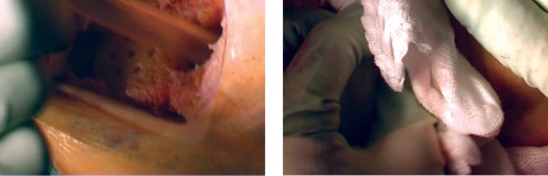 Illustration 29 for Cemented TKA Figure: Your Visual Guide to Surgical Success