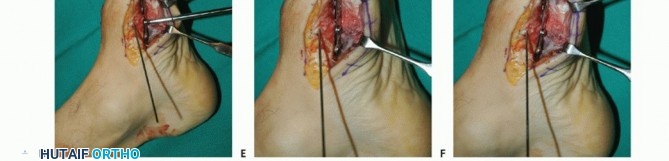 Illustration 72 for Mastering Midfoot Arthrodesis: Protect the Deep Neurovascular Bundle