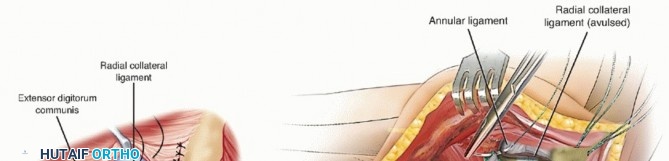 Illustration 20 for Radial Head Arthroplasty: Restoring Elbow Function & Stability