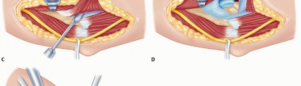 Illustration 56 for Surgical Approaches to Shoulder & Elbow: Pearls and Pitfalls