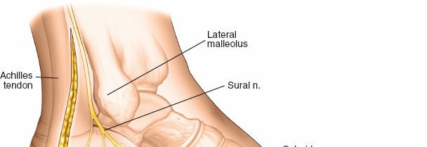 Illustration 13 for Mastering the Lateral Approach to the Posterior Talocalcaneal Joint