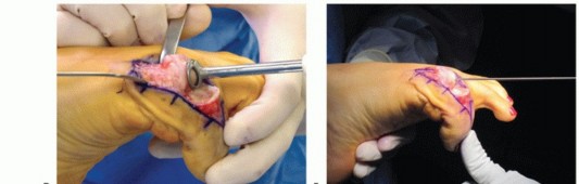 Illustration 18 for End Articular Cartilage Loss: Arthrosurface HemiCAP Resurfacing
