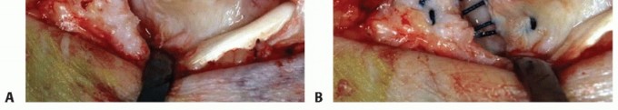 Illustration 33 for Medial Ankle Instability: Find Relief with Reconstruction