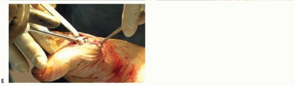Illustration 36 for End Articular Cartilage Loss: Arthrosurface HemiCAP Resurfacing