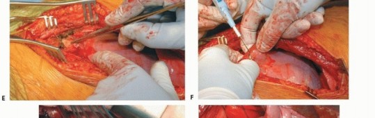 Illustration 26 for Anterior Interbody Arthrodesis for Scoliosis: What You Need to Know