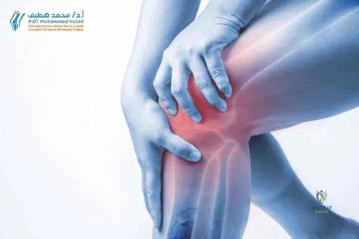 صورة توضيحية لركبة العدّاء تظهر مناطق الألم حول الرضفة