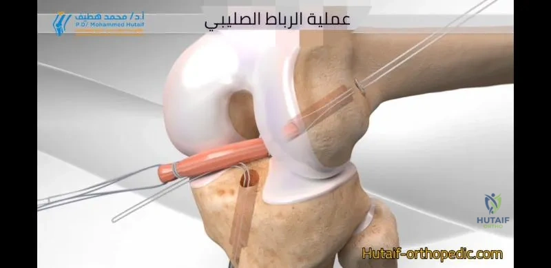 عداء يمارس تمارين الإطالة قبل الجري، يؤكد على أهمية الوقاية
