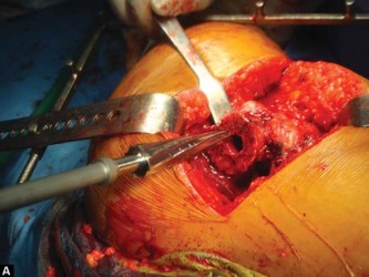 Illustration 42 for The Silent Hip: Achieving a Truly Silent, Pain-Free Joint