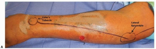 Illustration 19 for Optimal ORIF for Diaphyseal Forearm Fractures: Your Guide