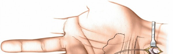Illustration 7 for Surgical Secrets: Anatomy of the Deep Palmar Space Revealed