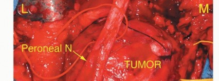 Illustration 18 for Optimizing Resection: An Overview of Surgical Approaches for Space Sarcomas