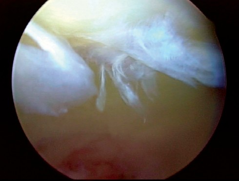 Illustration 18 for Essential Hip Arthroscopy Techniques for Optimal Outcomes