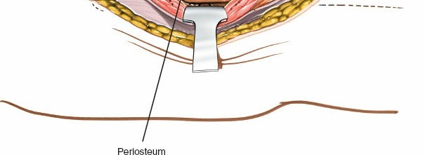 Illustration 10 for Optimal Femoral Approaches: Mastering the Lateral Intermuscular Septum