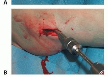 Illustration 28 for Is a Sliding Hip Screw Best for Your Femoral Neck Fracture?