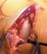 Illustration 6 for Knee Arthroplasty Unicondylar: Discover if Partial Knee Replacement is Right