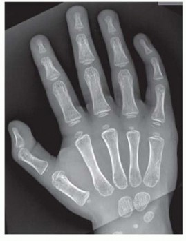 Mastering Polydactyly: Preaxial and Postaxial Types Explained